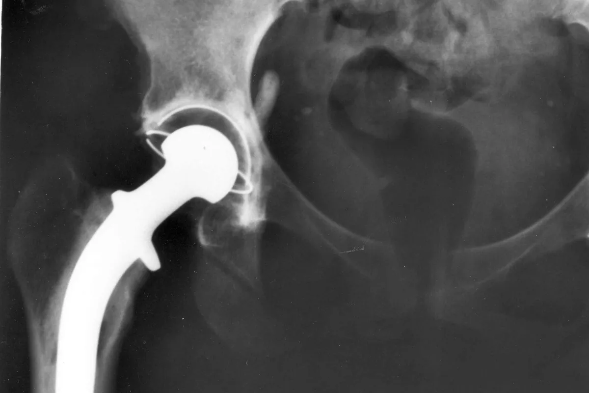 Radiografia da bacia com prótese total de quadril: haste metálica no fêmur e componente no acetábulo
